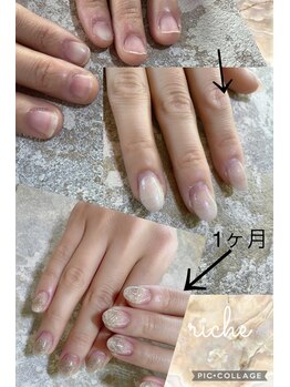 深爪育成スカルプ