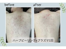 ウェルビー(Well-Be)/ハーブピーリング＋プラズマ導入