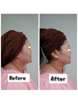 プロジェクトサン ムーンベル(PROjECTSuN Moonbell)/ラジオ波+ポレーション