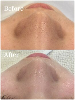 ビビィ(Bibiy)/毛穴洗浄