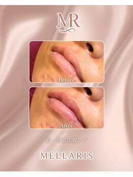 アンテサロン 関内店(Antesalon)/次世代メラニンケア「メラリス」