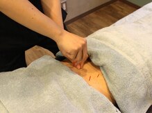 浦和メディケア接骨院 鍼灸院/腰痛（鍼）