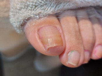 爪切り屋 足楽/巻いた爪◆60代女性