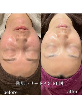 ビエン(bien)/施術6回.陶肌ハーブピーリング