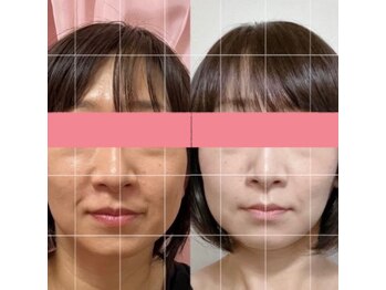 サロンペタル 浦安(Salon Petal)/たるみが減って若々しく