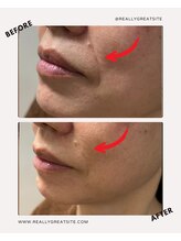 ユーフォリア(Euphoria)/ほうれい線対策に表情筋リフト