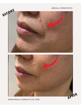 ユーフォリア(Euphoria)/ほうれい線対策に表情筋リフト