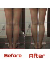 ビタミンスパ アンド ボーテ 三軒茶屋店/カッサ痩身ビフォーアフター写真