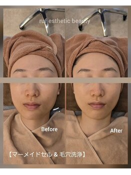 ルフ エステティック ビューティー(ruf esthetic beauty)/マーメイドセル+毛穴洗浄