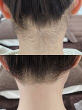 アール(R)/うなじ脱毛(wax&光)