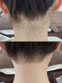 アール(R)/うなじ脱毛(wax&光)