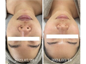 エステサロンブランシュ(Esthe salon Blanche)/ハーブピーリングで毛穴ケア