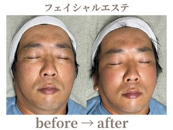 サロンラペーシュ(Lapeche)/フェイシャル befor→after