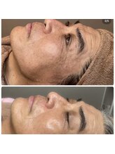 ブルーム(bloom)/ハーブピーリング/ララピール