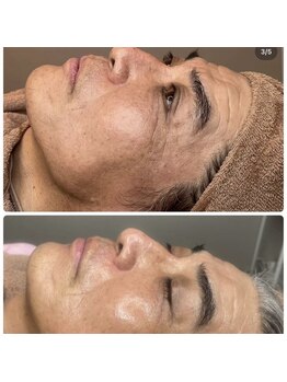 ブルーム(bloom)/ハーブピーリング/ララピール