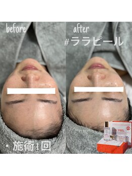 ヌン(NUN.)/ララピーリング