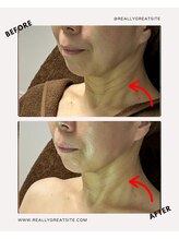 ユーフォリア(Euphoria)/見逃しがちの首のシワ改善