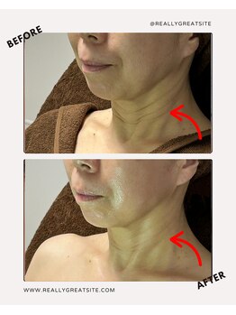 ユーフォリア(Euphoria)/見逃しがちの首のシワ改善