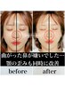 【鼻集中】鼻の歪み・曲がり・低い人向け体験［小顔矯正/鼻・頬骨/上顎骨］