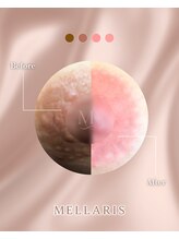 アンテサロン 関内店(Antesalon)/メラリスで乳輪の黒ずみ改善♪