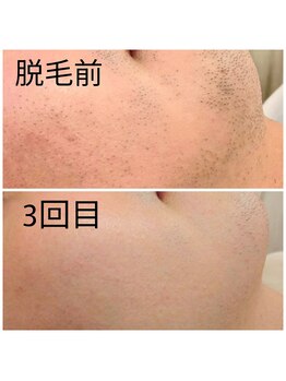 エミナル(EMINAL)/~脱毛効果~保湿が大事!