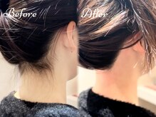 ピミル(PIMIL)/うなじ脱毛