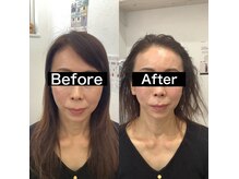 エスピーエー 桂坂(S.P.A)の雰囲気(一回の施術でもフェイスラインがスッキリ!)