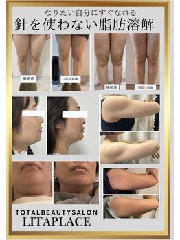 リタプレイス 琴似(LITAPLACE)の写真/気になる部分をピンポイントケア！大人気の針を使わない脂肪分解ケア！！し放題毎月5名様限定！