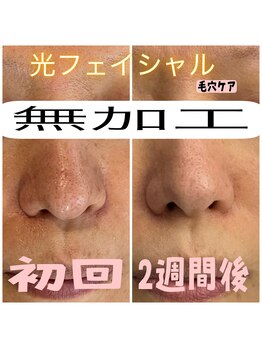 リンク(LiNK)/光の力で毛穴開き1回目2週間後☆