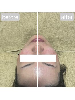 エイル ビューティ ホヌ(EIL beauty Honu)/エアバリ+美容液導入