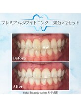 シェア(SHARE)/セルフホワイトニング
