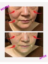 ユーフォリア(Euphoria)/お顔全体のリフトアップ効果