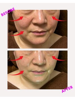 ユーフォリア(Euphoria)/お顔全体のリフトアップ効果