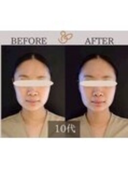 チョコバリ 錦糸町店(chocobari)/小顔×リフトアップ(美容鍼)10代