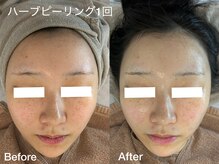 プティ 横浜店(Petit)/韓国式ハーブピーリング