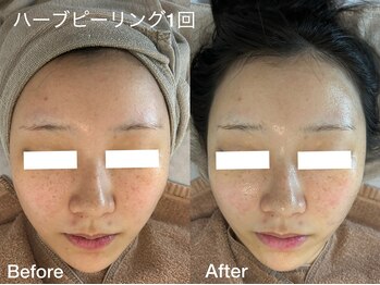 プティ 横浜店(Petit)/韓国式ハーブピーリング