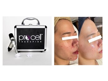 レイ(Rey)/最新肌質改善プロセルセラピーズ