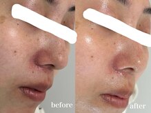 リアルナ(REALUNA)/赤み／敏感肌