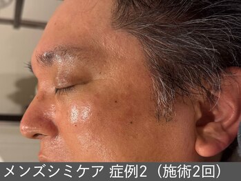 オアシスラグーン(OASIS LAGOON)/メンズシミケア(症例2施術2回)