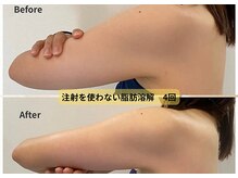レミュ(Remu)の雰囲気（【脂肪燃焼液導入】二の腕）