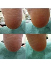 上高田つつじ整体院/フットケア　角質ケア　例