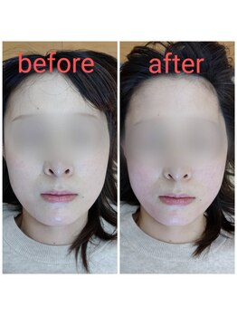 美藤鍼灸院/美容鍼のBefore After