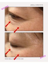 ユーフォリア(Euphoria)/目元の小じわ、皮膚深部から