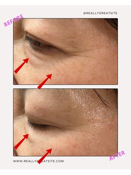 ユーフォリア(Euphoria)/目元の小じわ、皮膚深部から