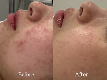 リフコウベ(LIF KOBE)/乾燥・赤み・痒み◇アンストレス