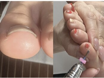 ルミエールサント(lumiere sainte)の写真/【巻き爪ケア・フットケア付♪】爪の端が皮膚に食い込む・歩く・靴を履くときのズキズキした痛みから解放♪