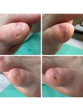 巻き爪補正店 越谷店/副爪(小指の横にできる硬い角質)