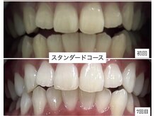 ホワイトニングショップ 明石大久保店/【BeforeAfter】