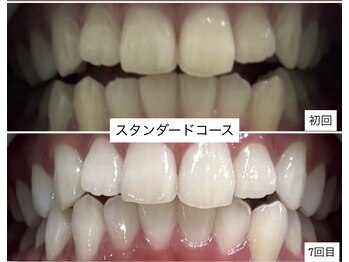 ホワイトニングショップ 明石大久保店/【BeforeAfter】