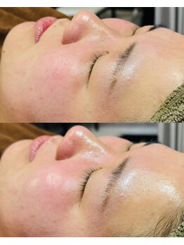 ルーク(Luke)/ニキビケア／くすみ／毛穴